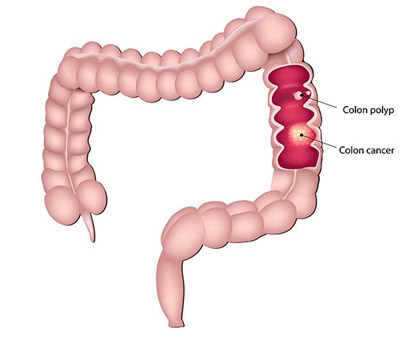 Colorectal Cancer Surgery Terms