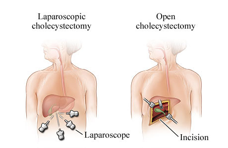 Types of Gallbladder Surgery