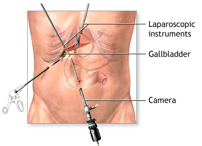 Gall Bladder Surgery