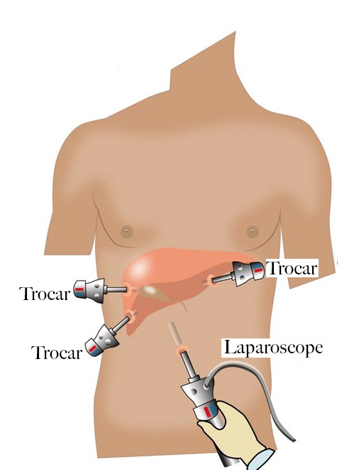 Laparoscopic Open GI Cancer Surgery